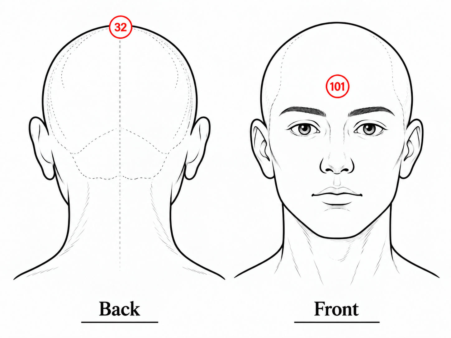 Head Hijama chart showing Point 32 on the top of the head and Point 101 on the central forehead