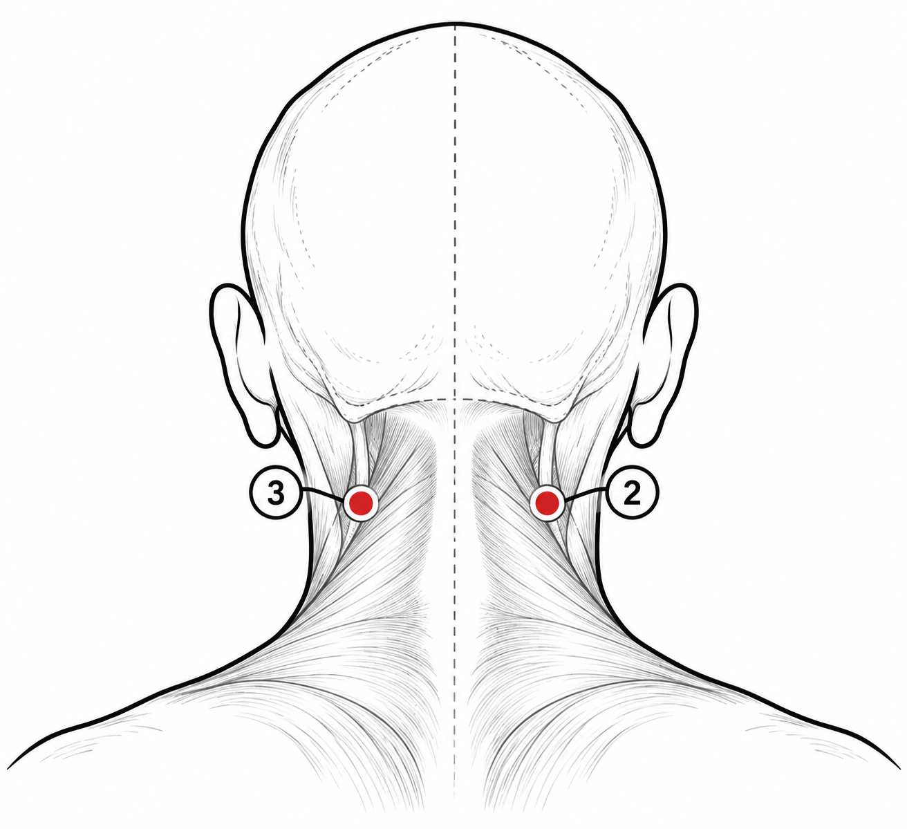 Al-Akhdaayn Sunnah Hijama points on both sides of the upper neck, shown as points 2 and 3