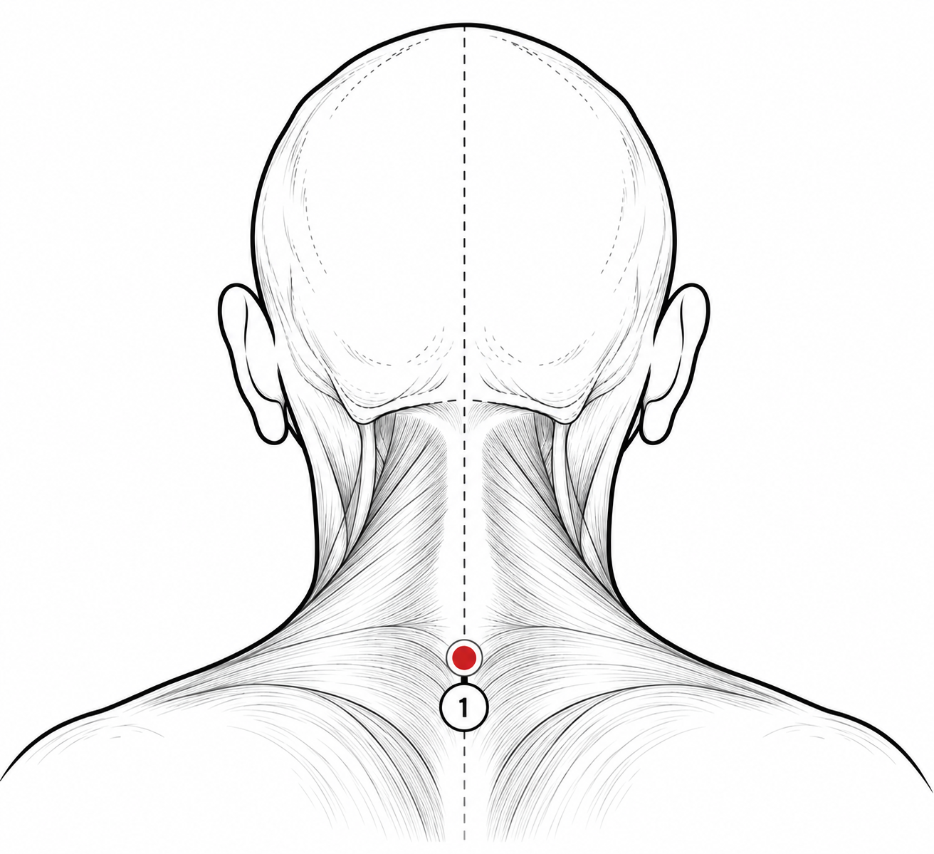 Al-Kahil Sunnah Hijama location shown as Point 1 on the upper back